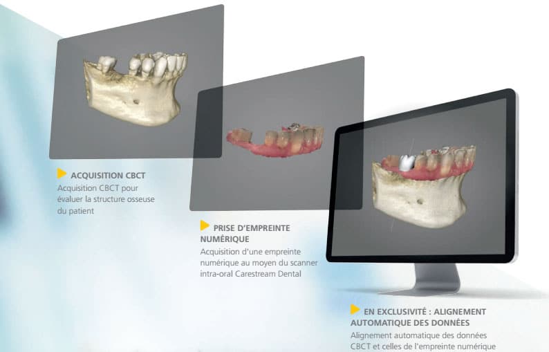 pdip_cs_solutions_for_implants_planification