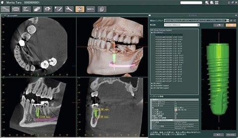 veraviewpocs_3D_R100_implants